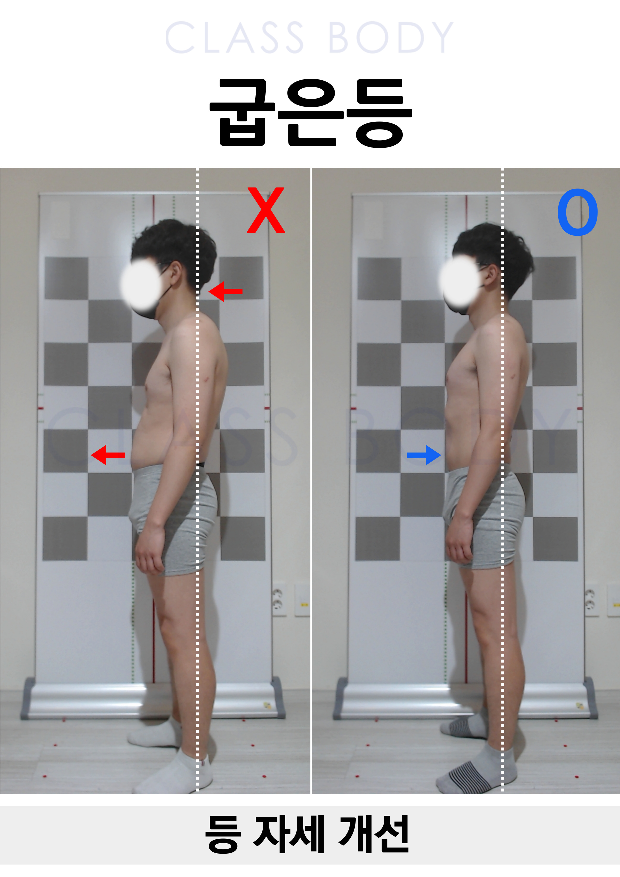 굽은등 개선