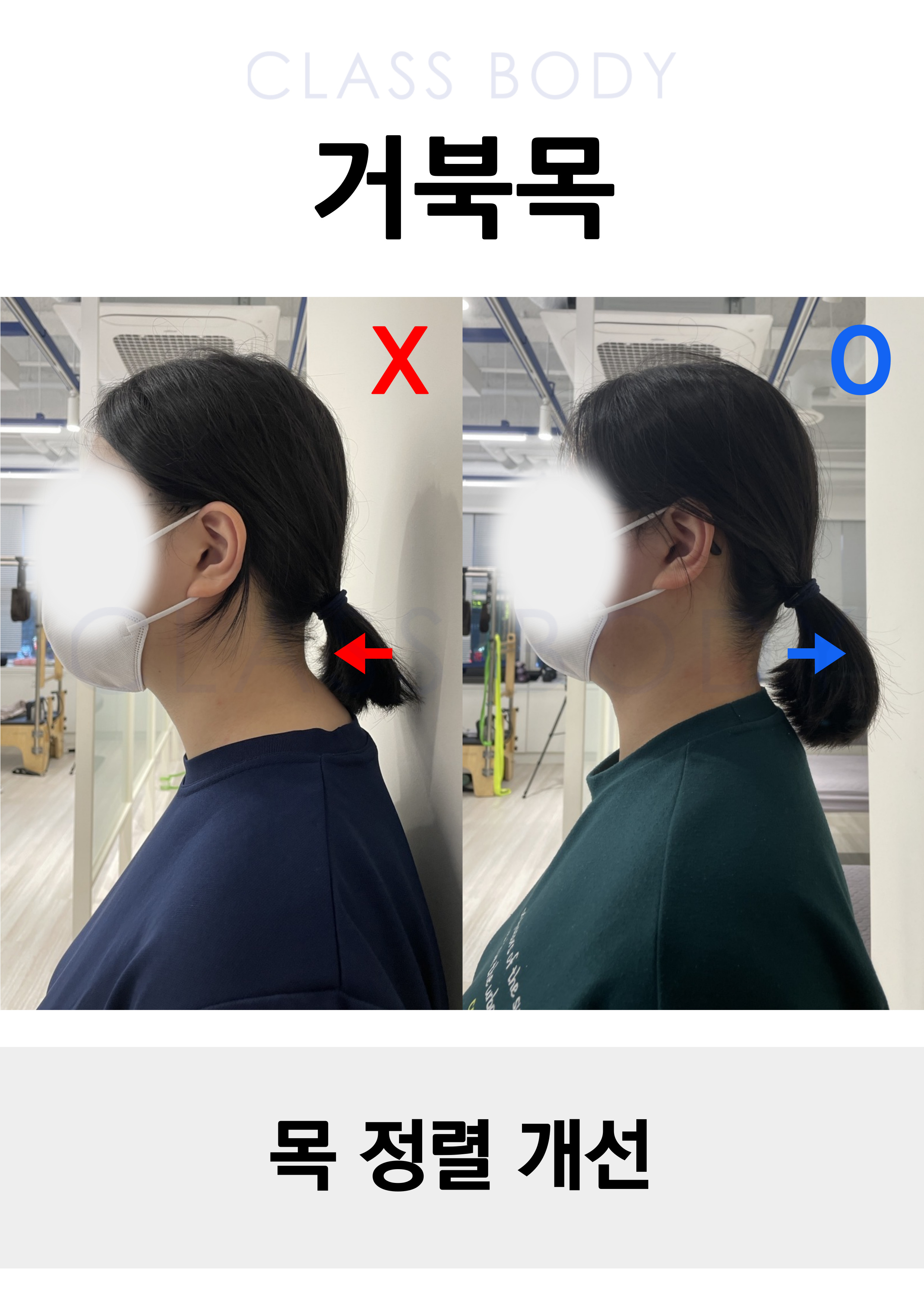 거북목 개선