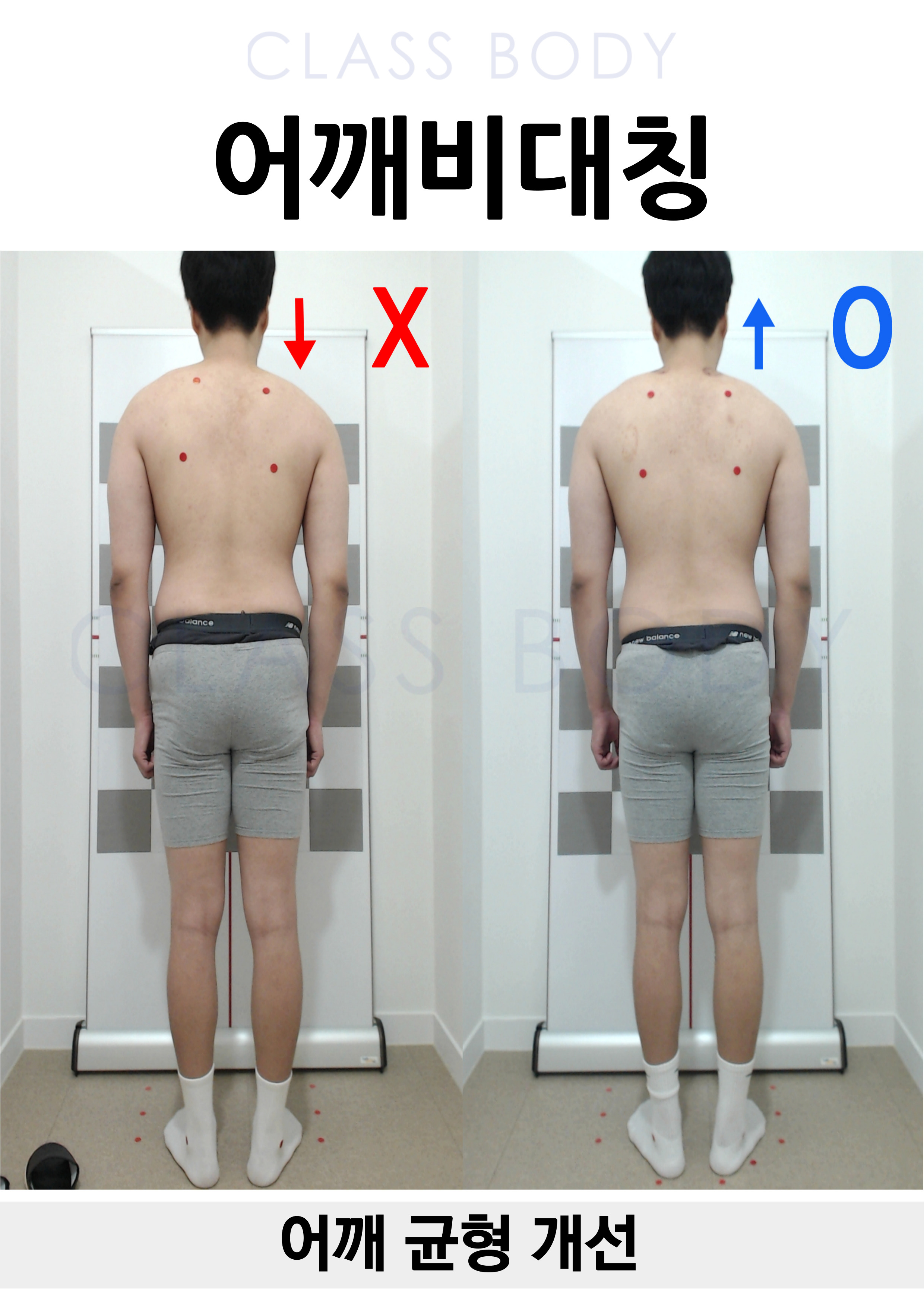 어깨 비대칭 개선
