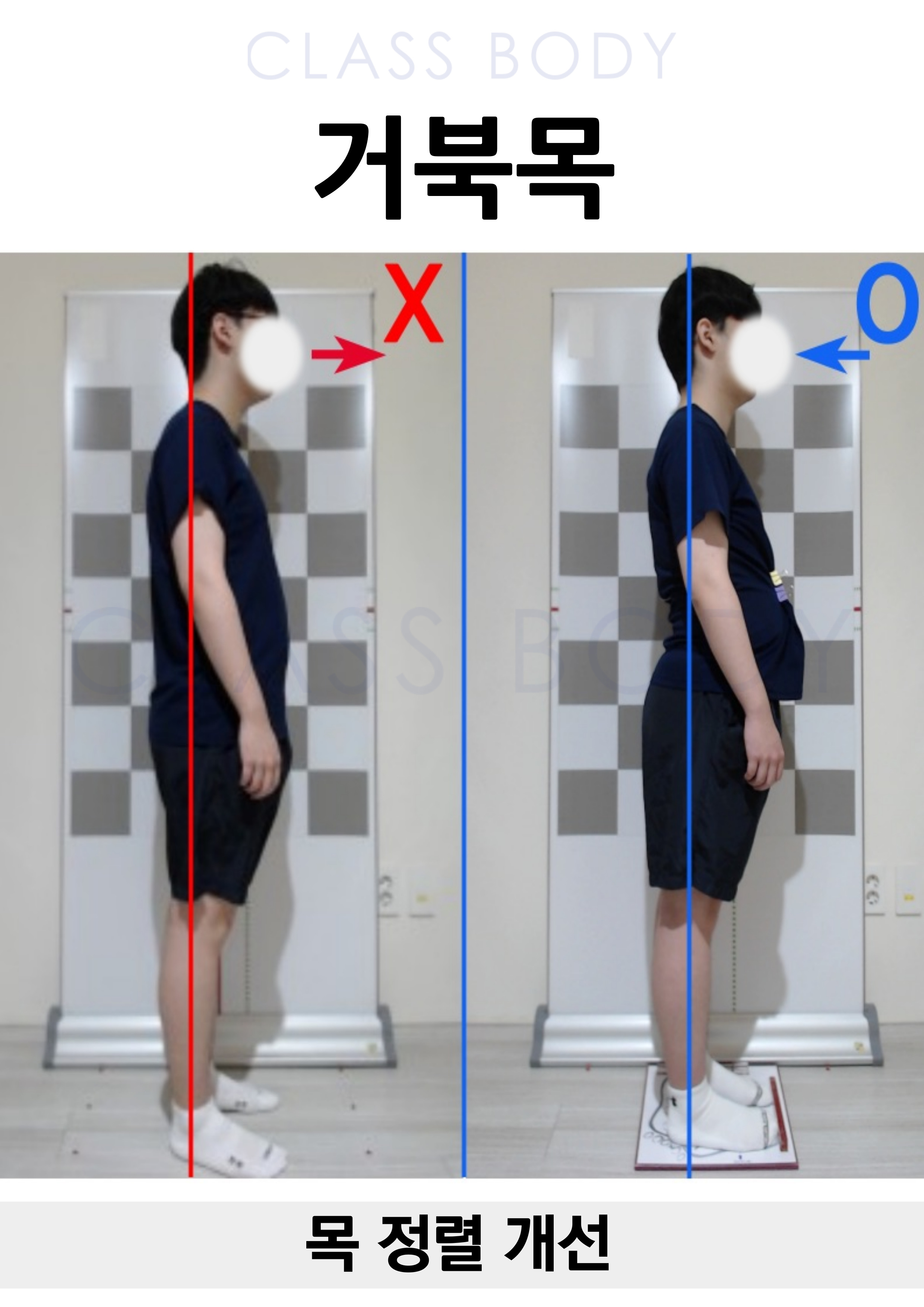 거북목 개선