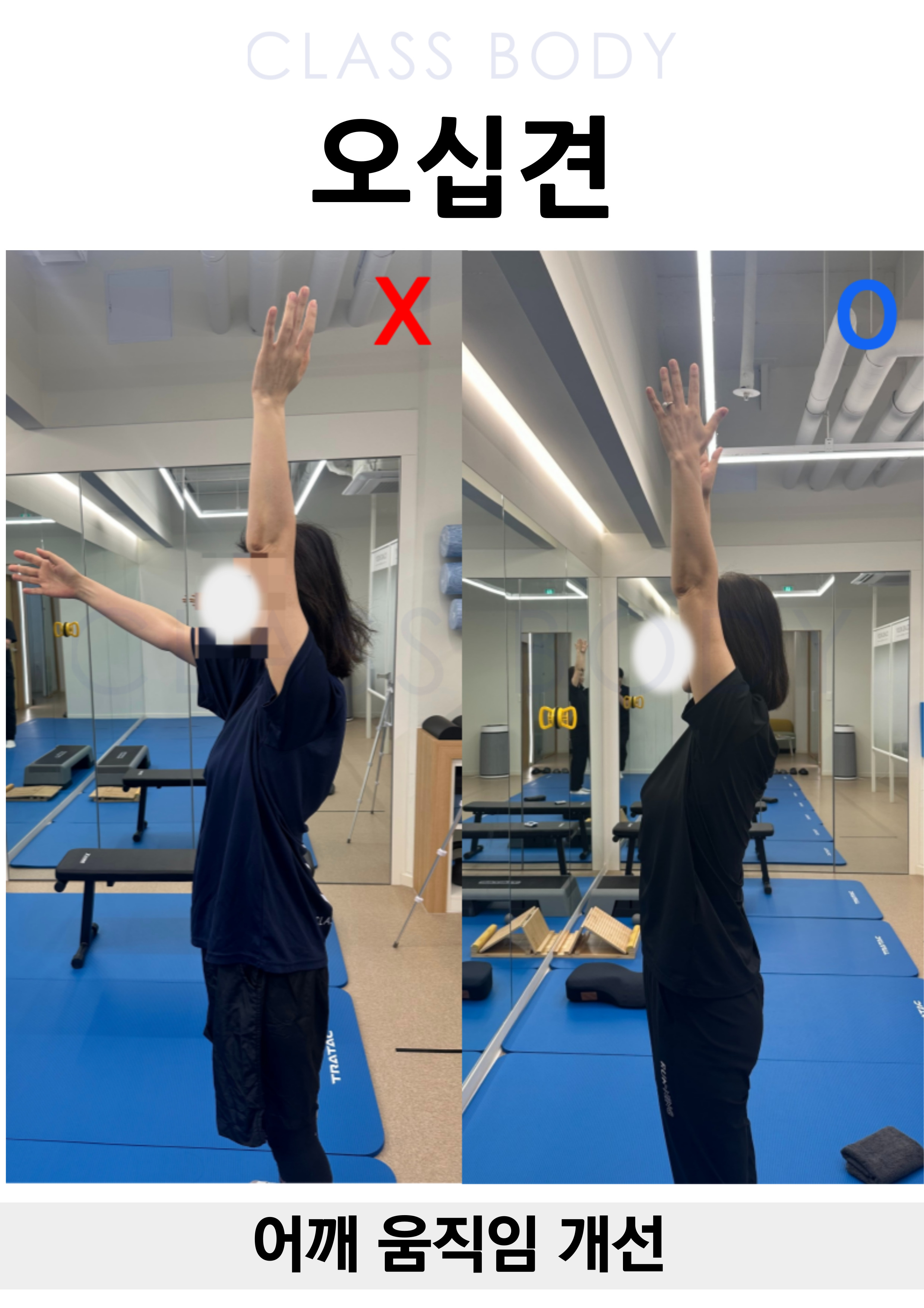 오십견 개선