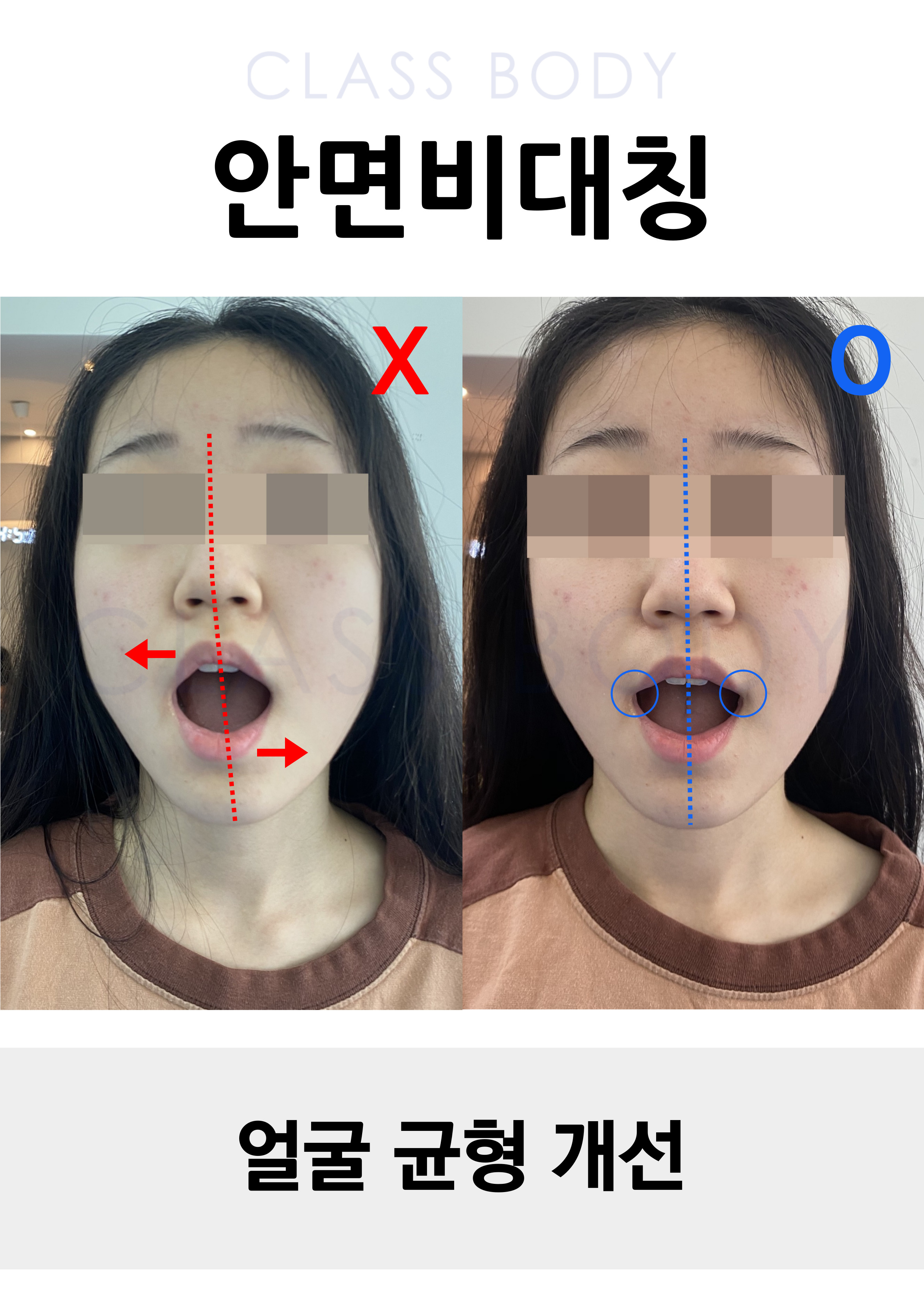 안면비대칭 개선