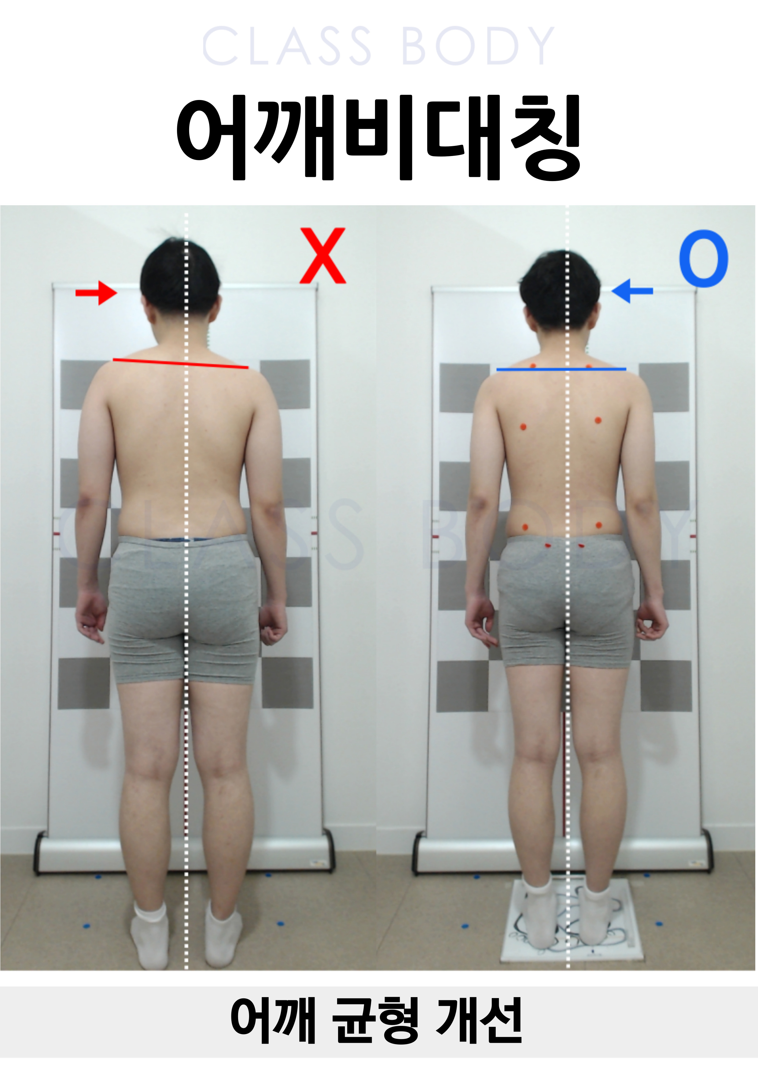 어깨비대칭 개선