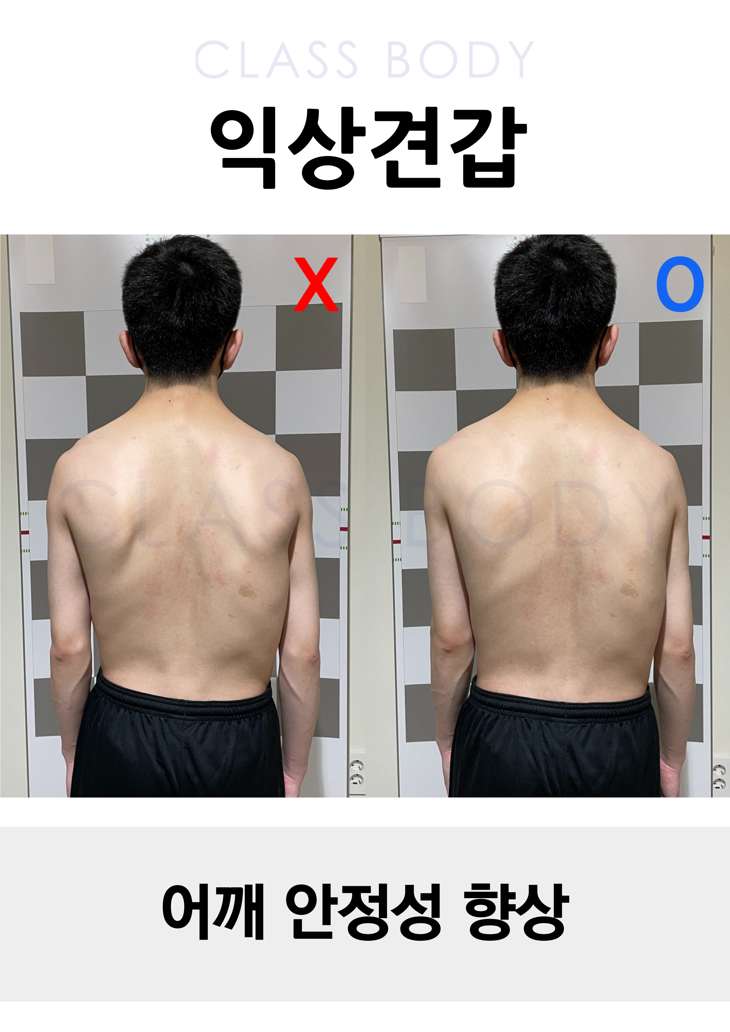 익상견갑 개선