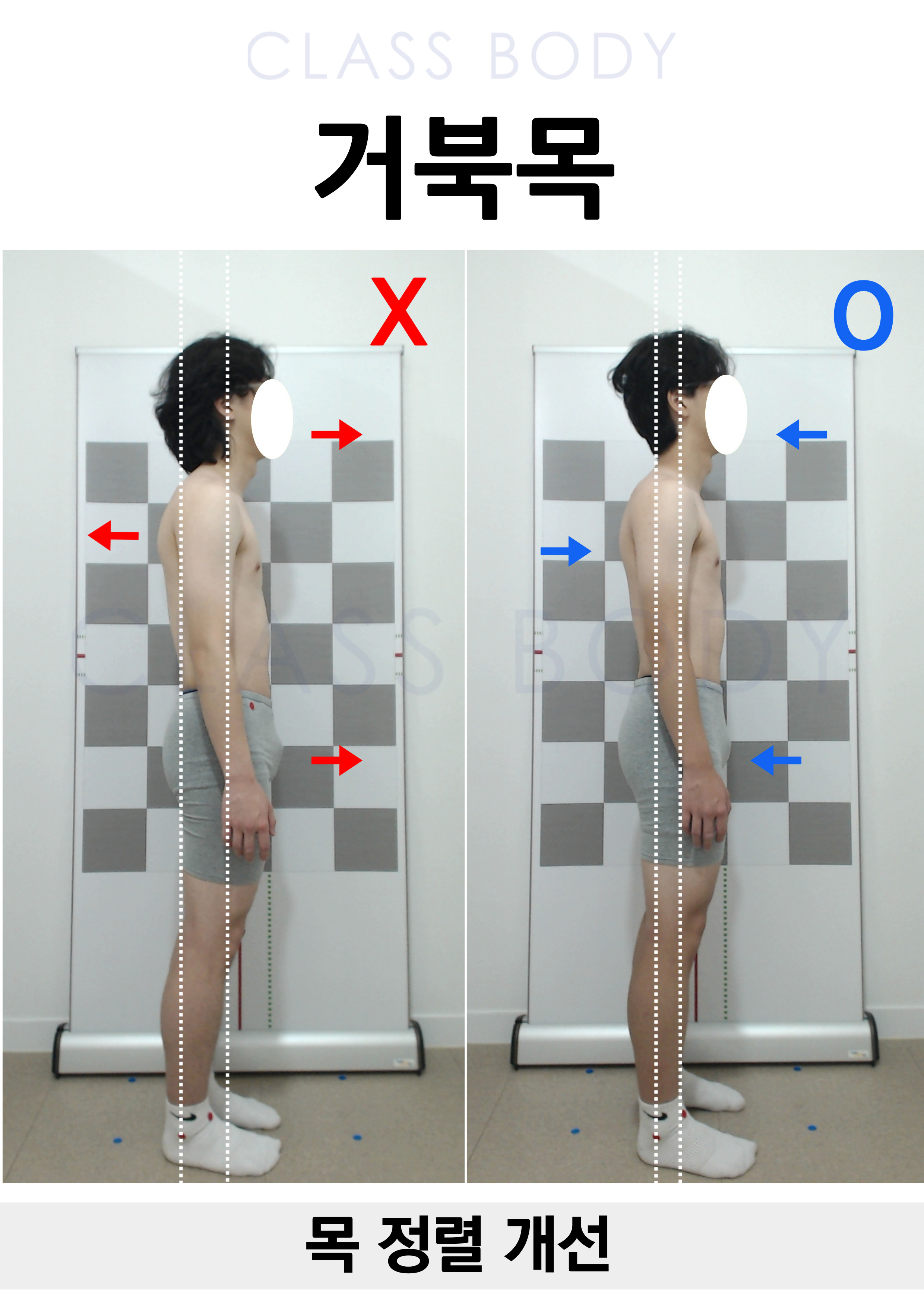 거북목 개선