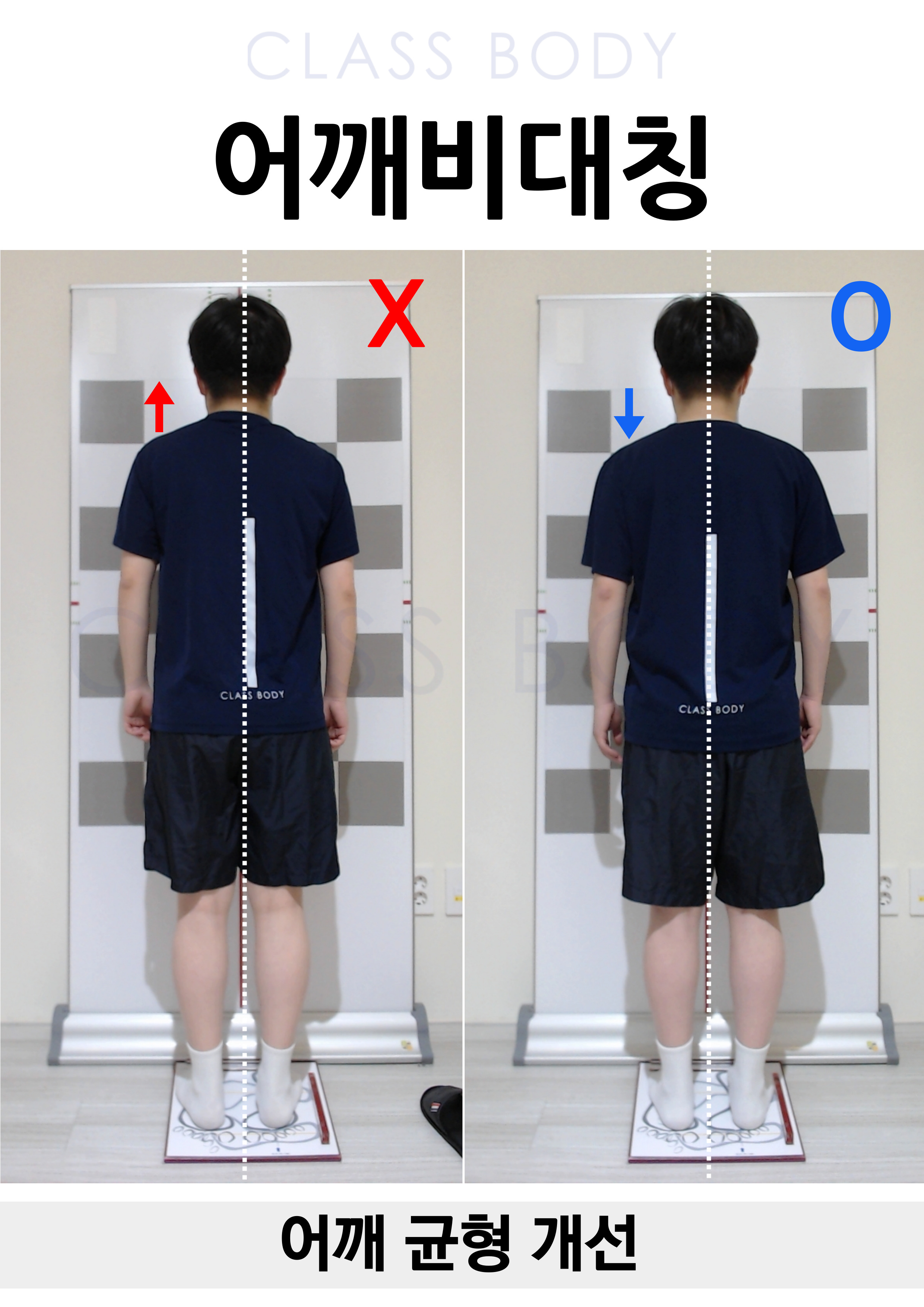 어깨비대칭 개선