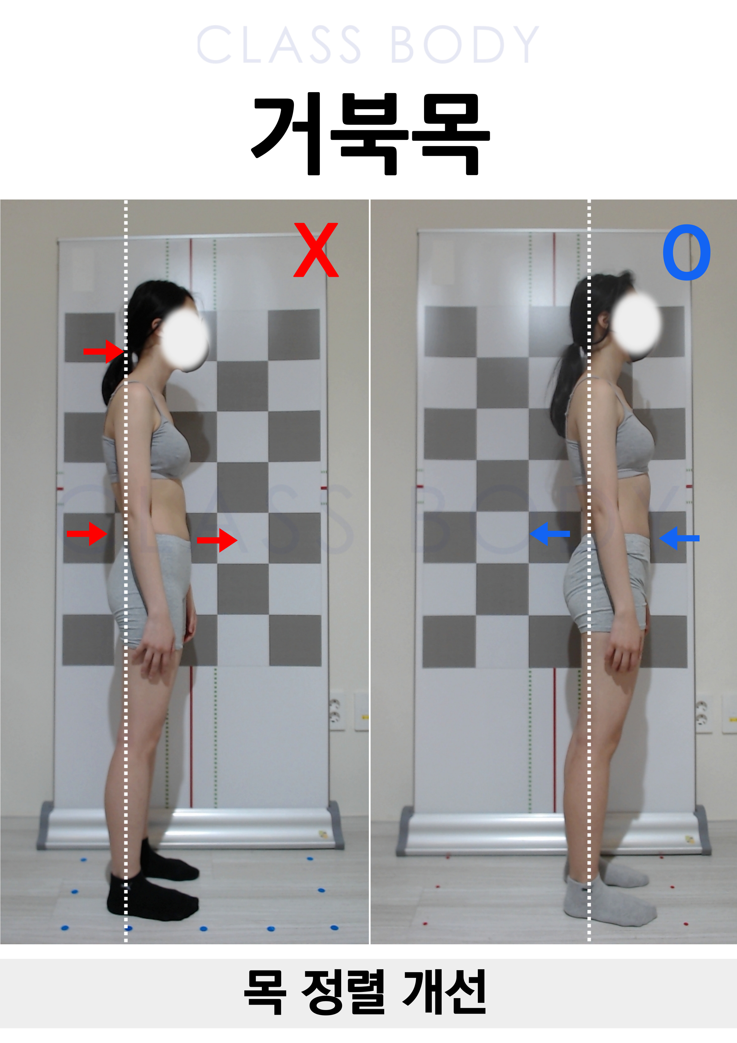 거북목 개선