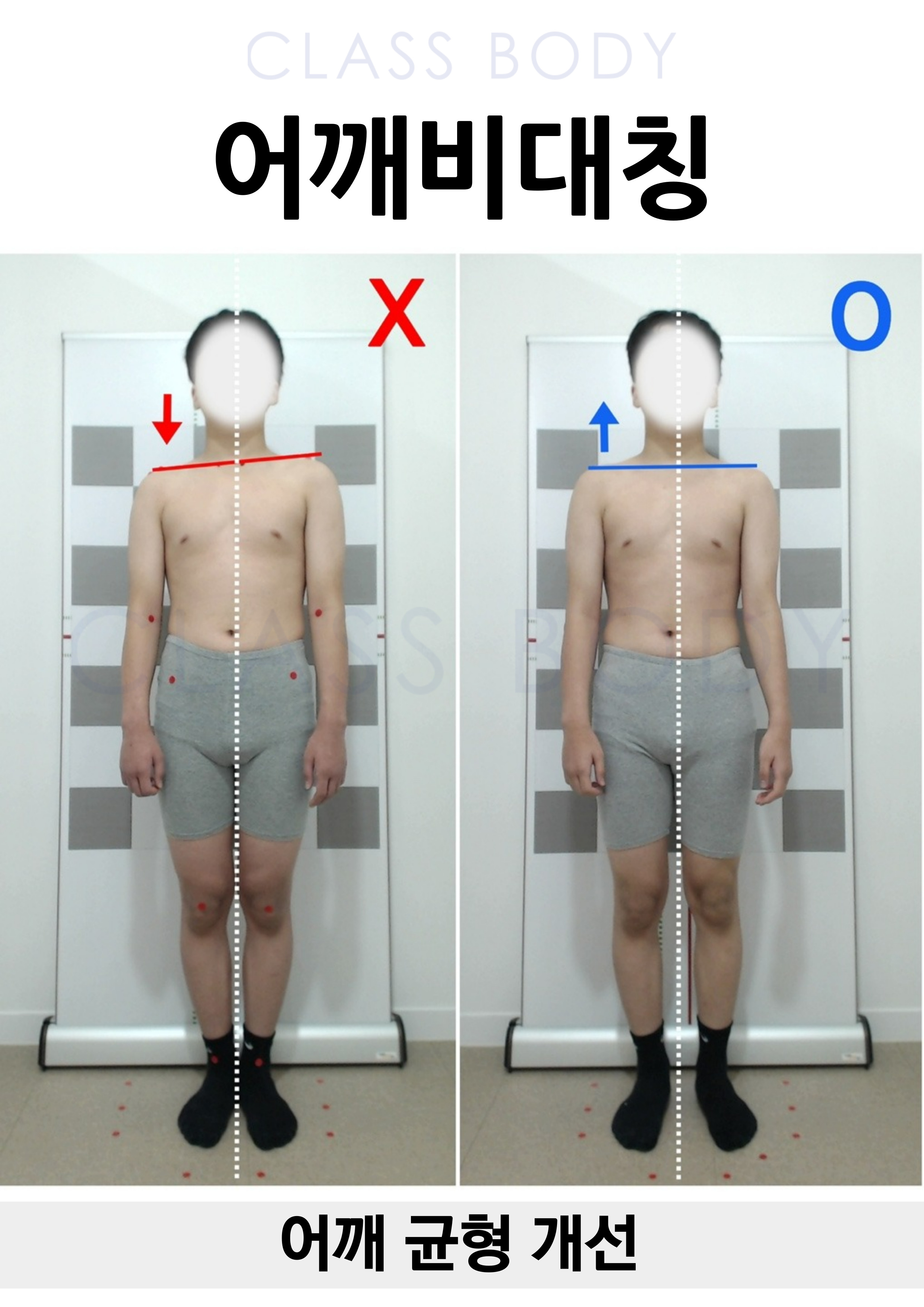 어깨비대칭 개선