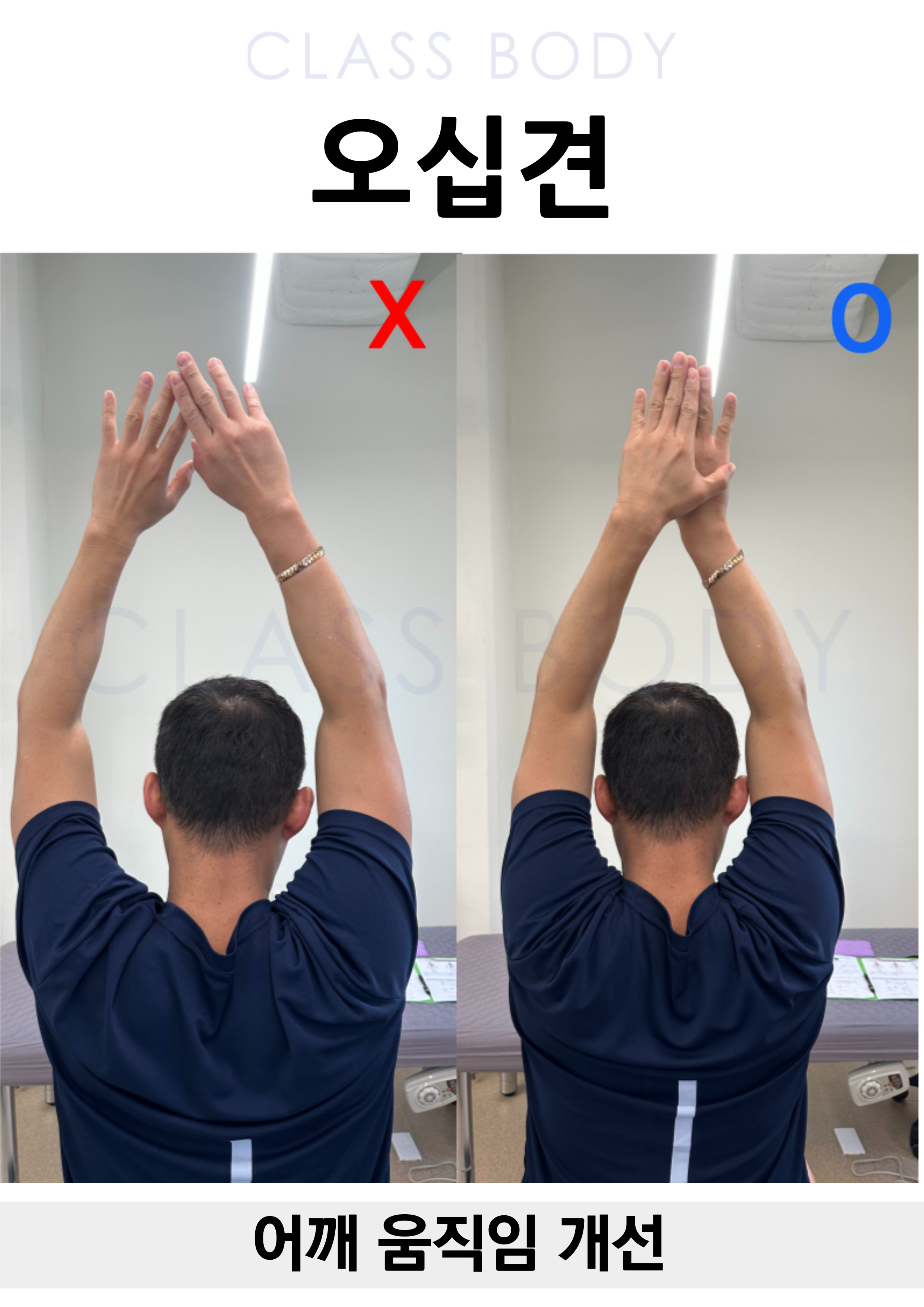 오십견 개선