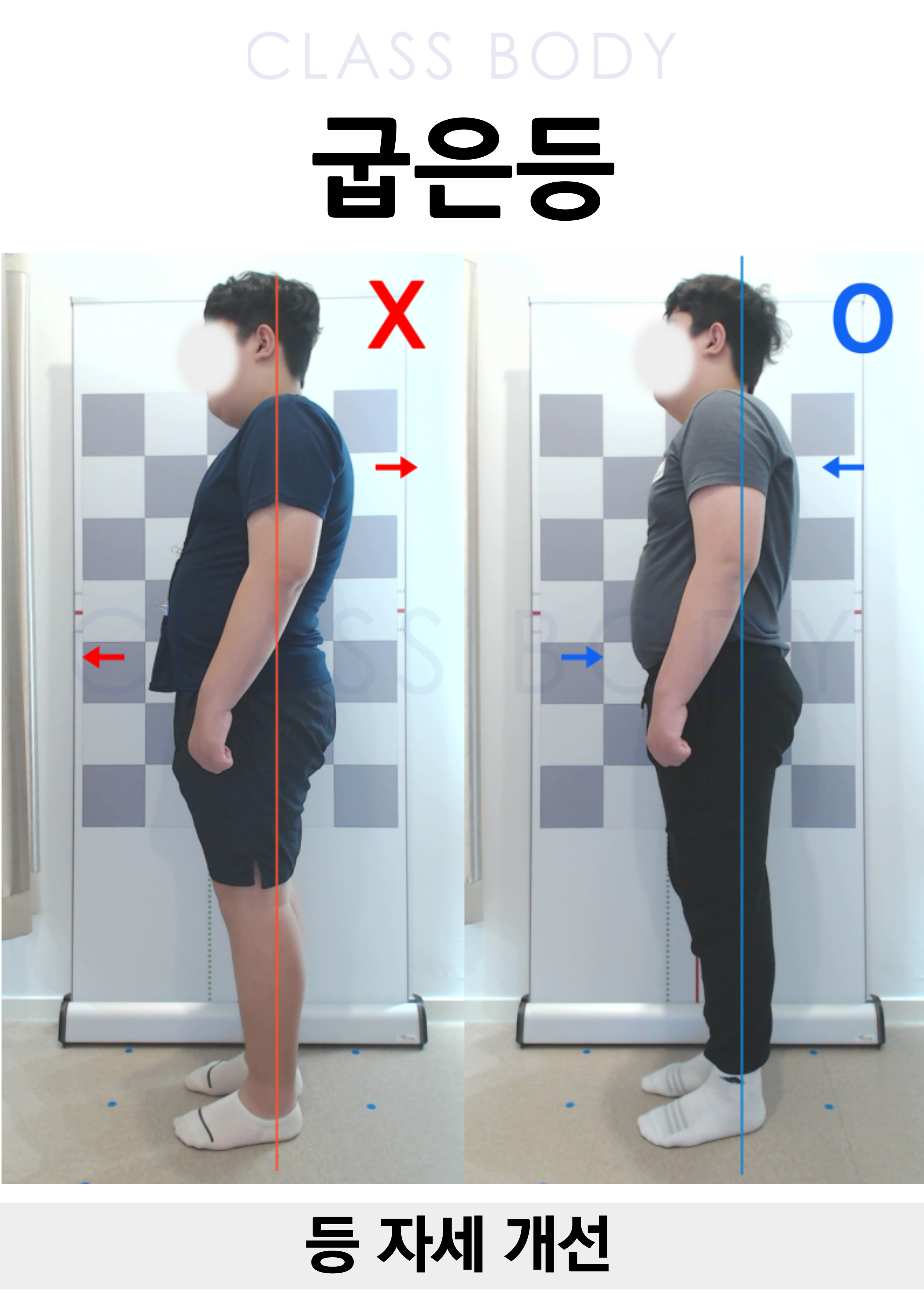 굽은등 개선