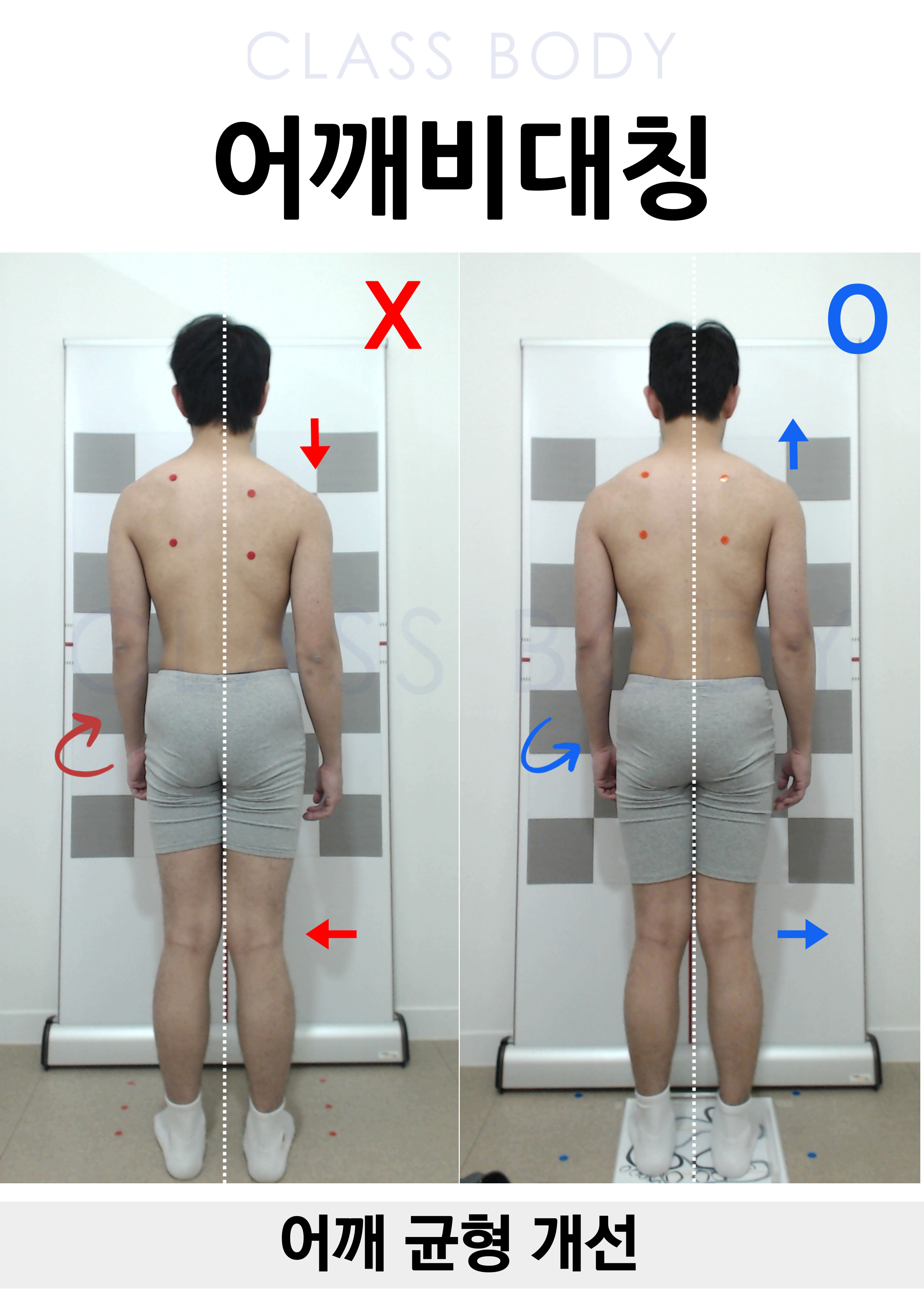 어깨비대칭 개선