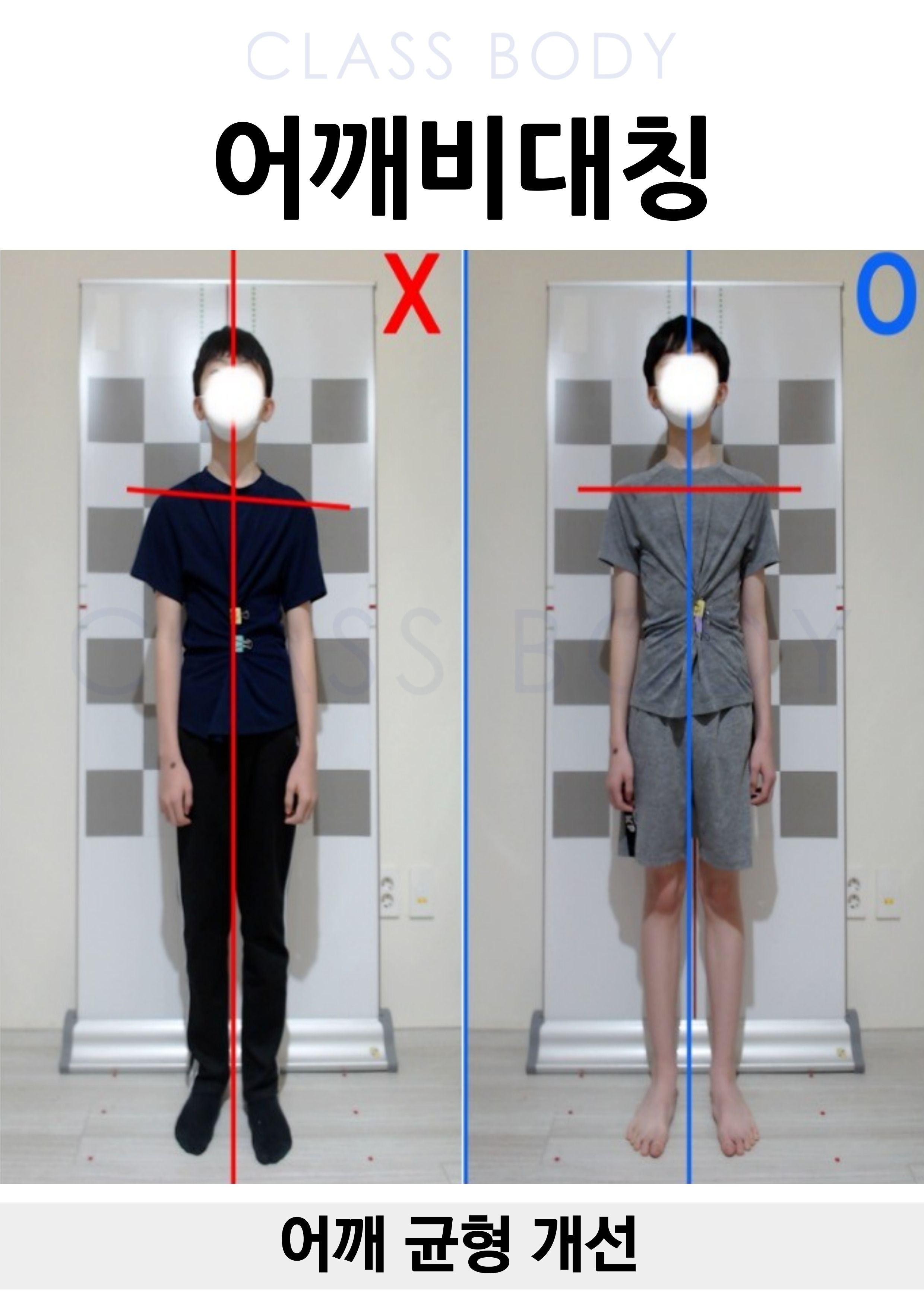 어깨비대칭 개선