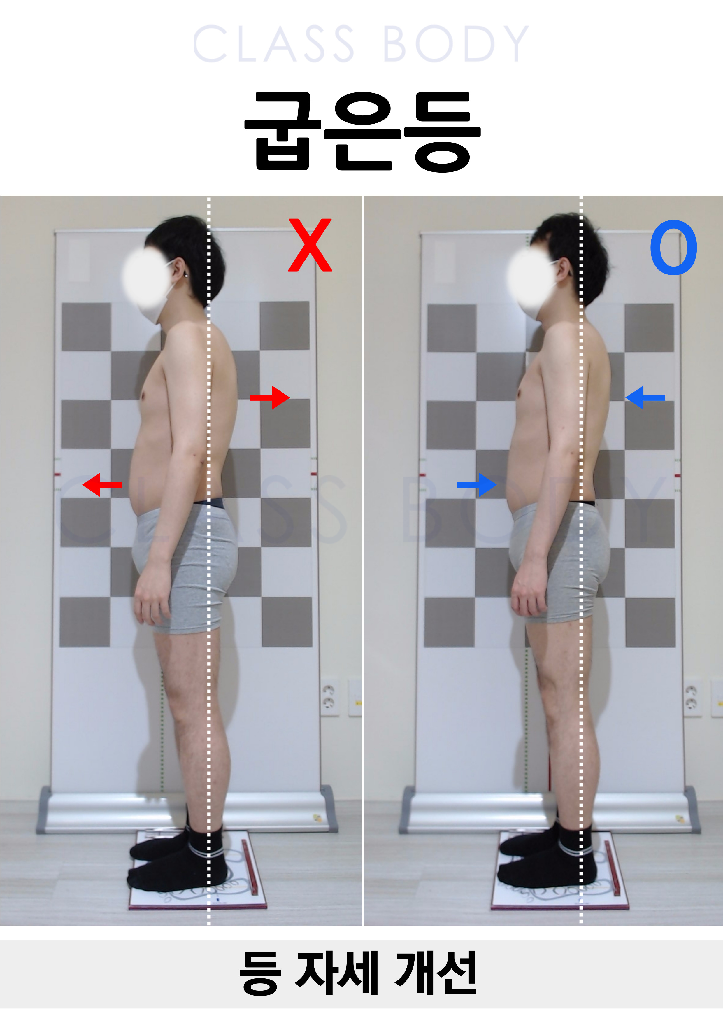 굽은등 개선