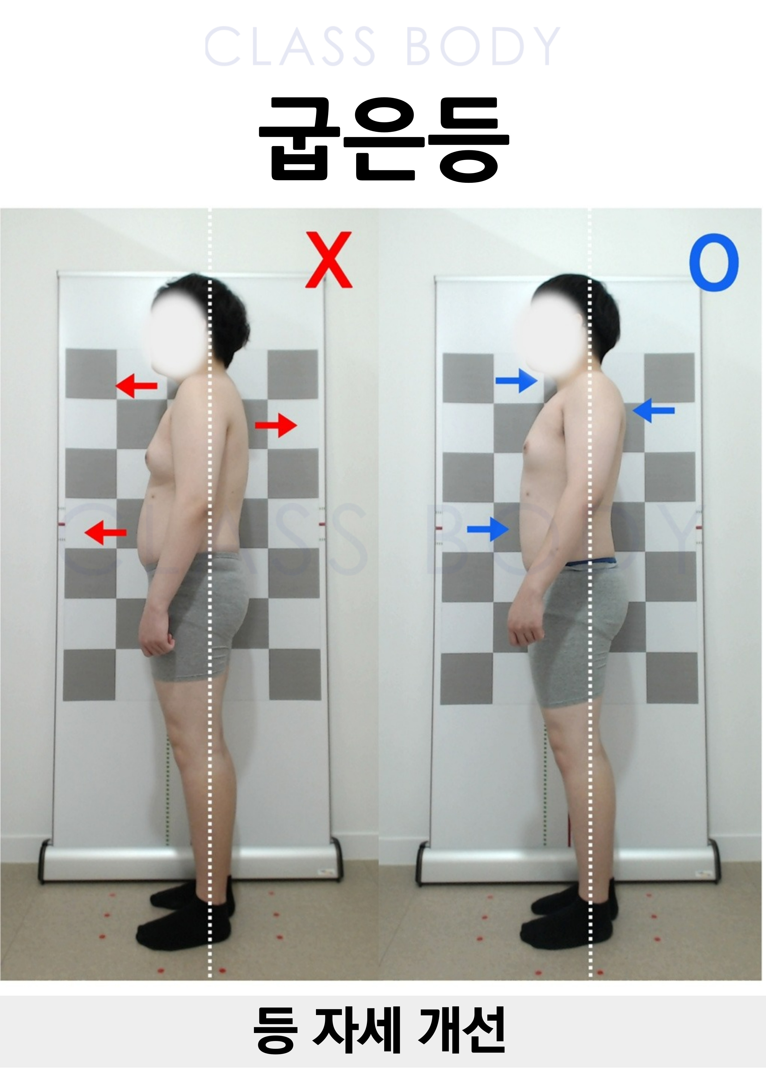 굽은등 개선