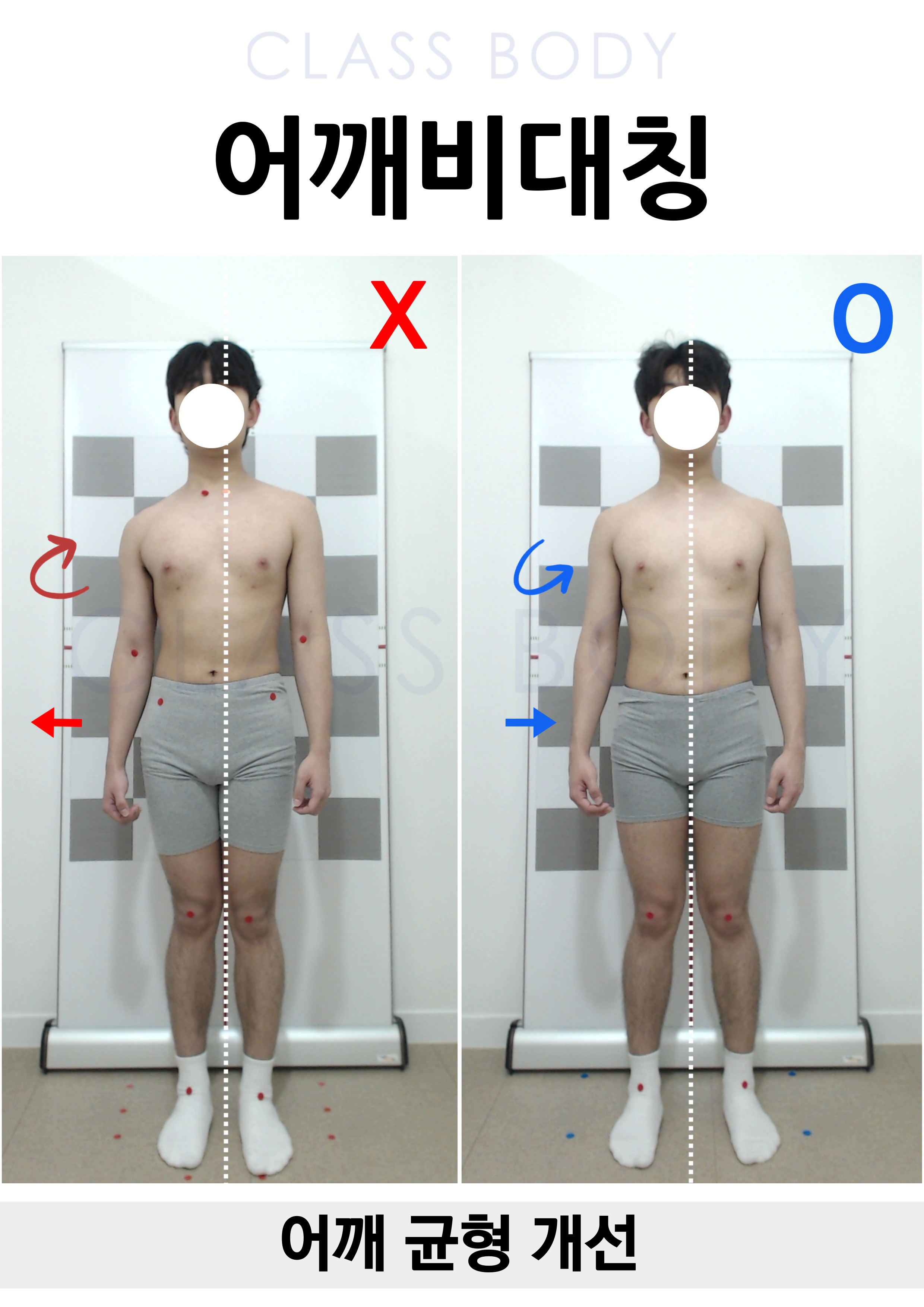 어깨비대칭 개선