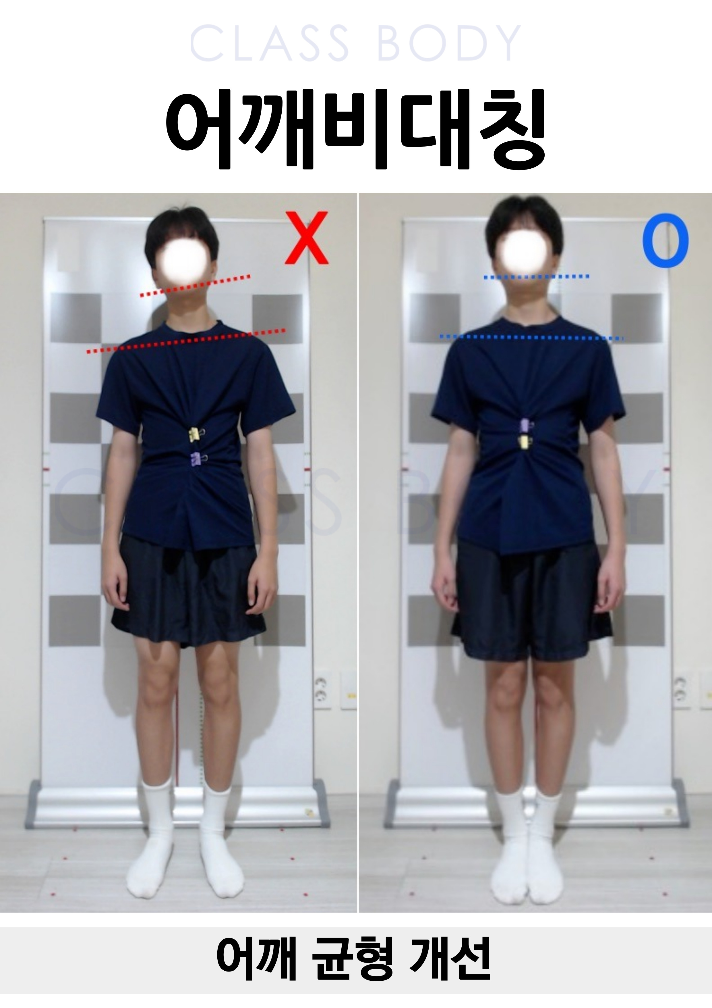 어깨비대칭 개선
