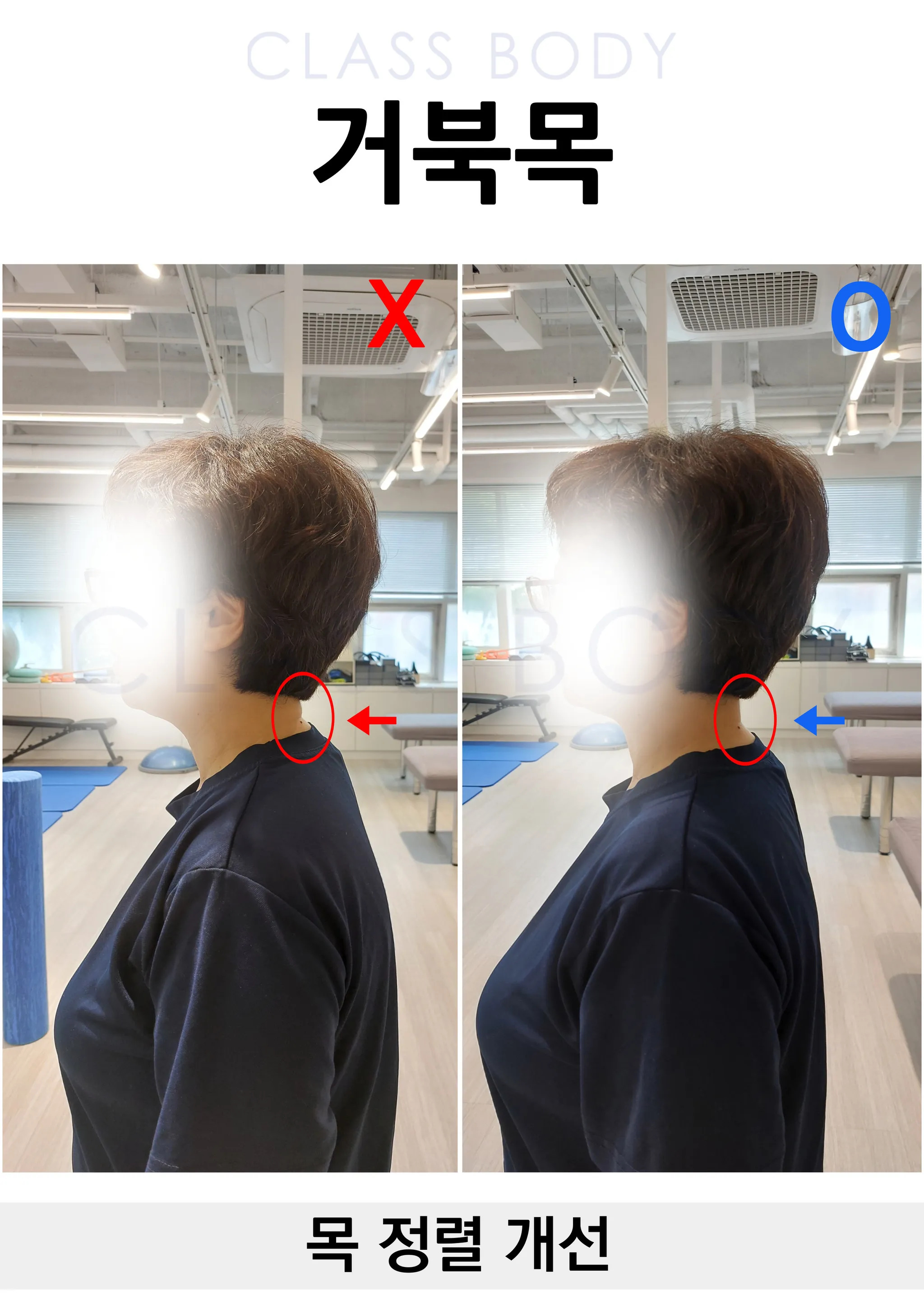 거북목 개선