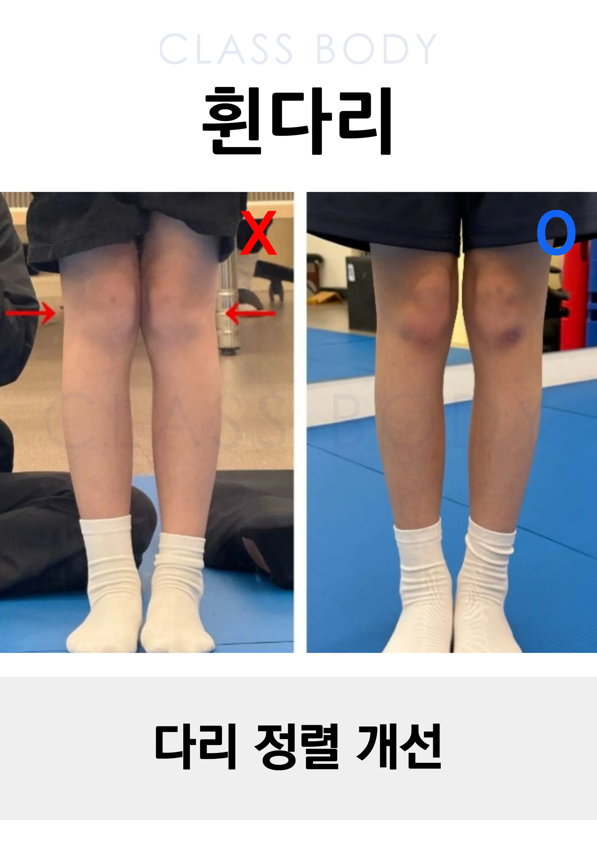 다리 정렬 개선