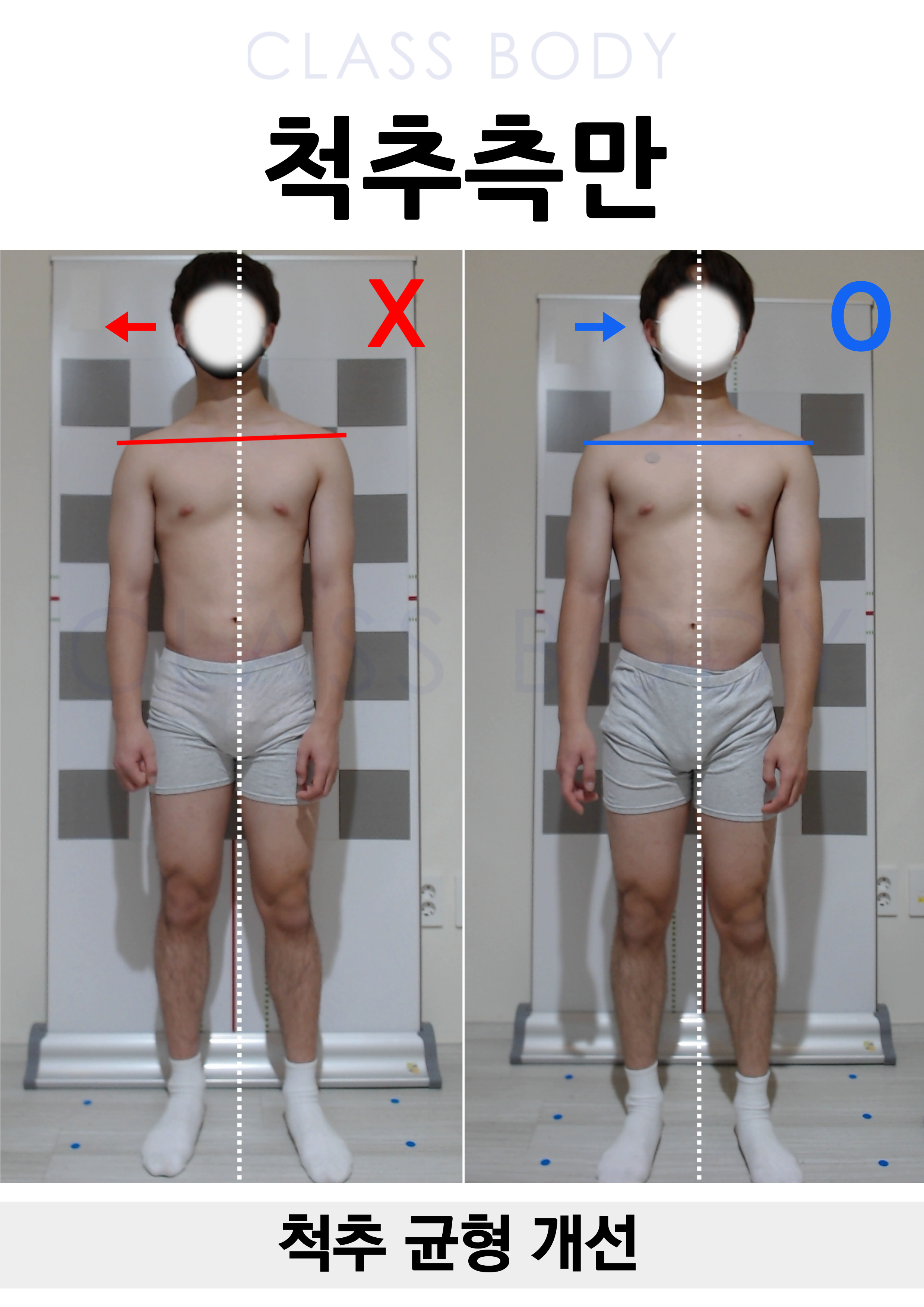 척추측만개선