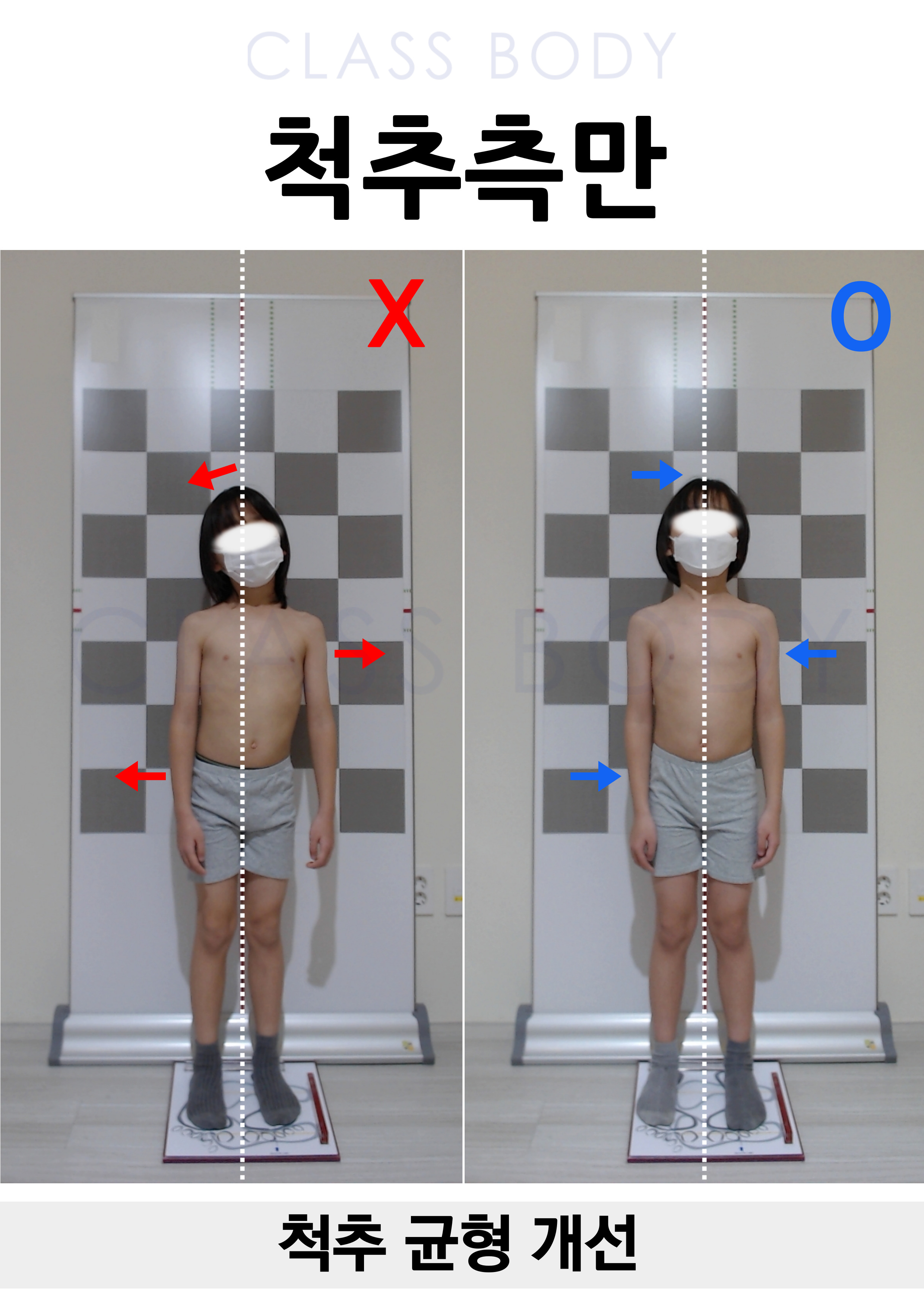 척추측만개선
