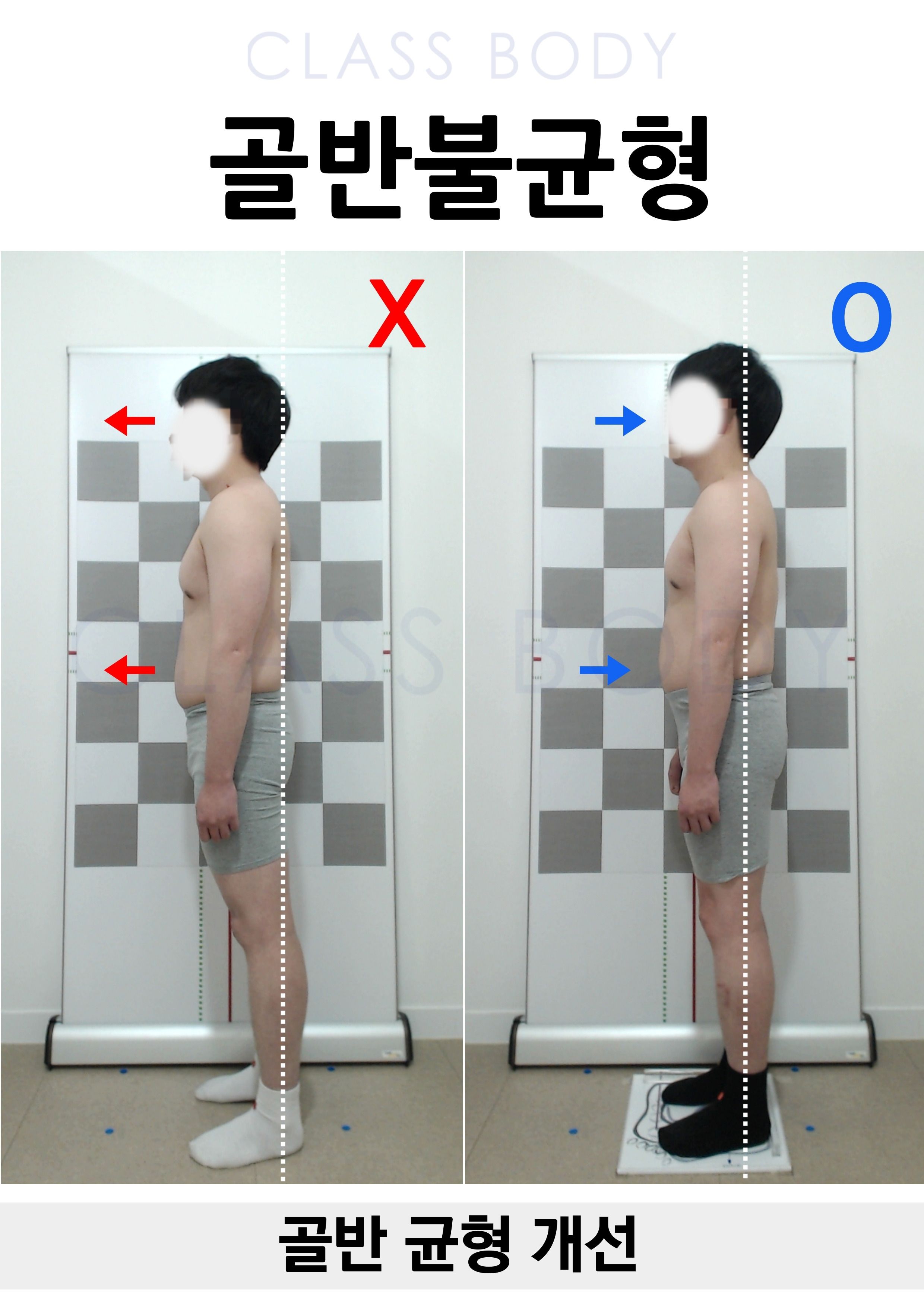 골반 균형 개선