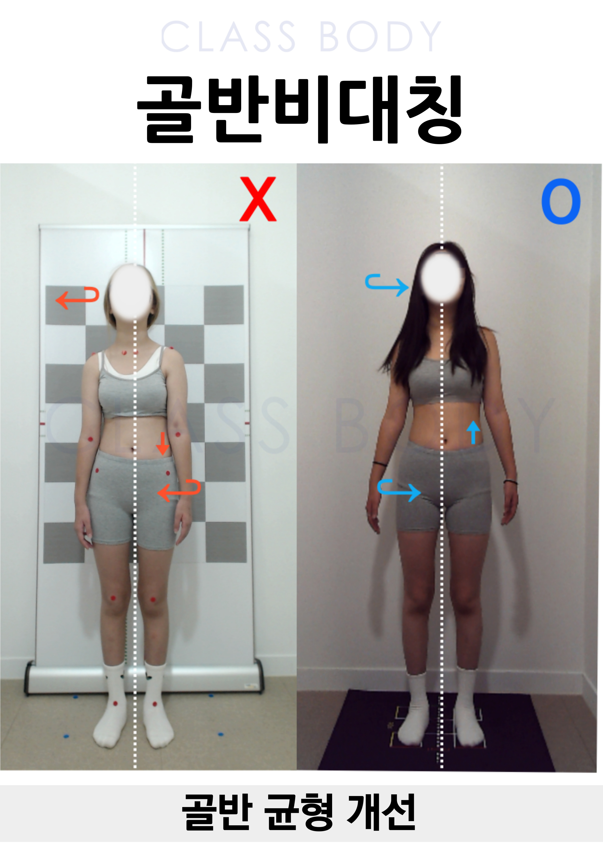 골반 균형 개선
