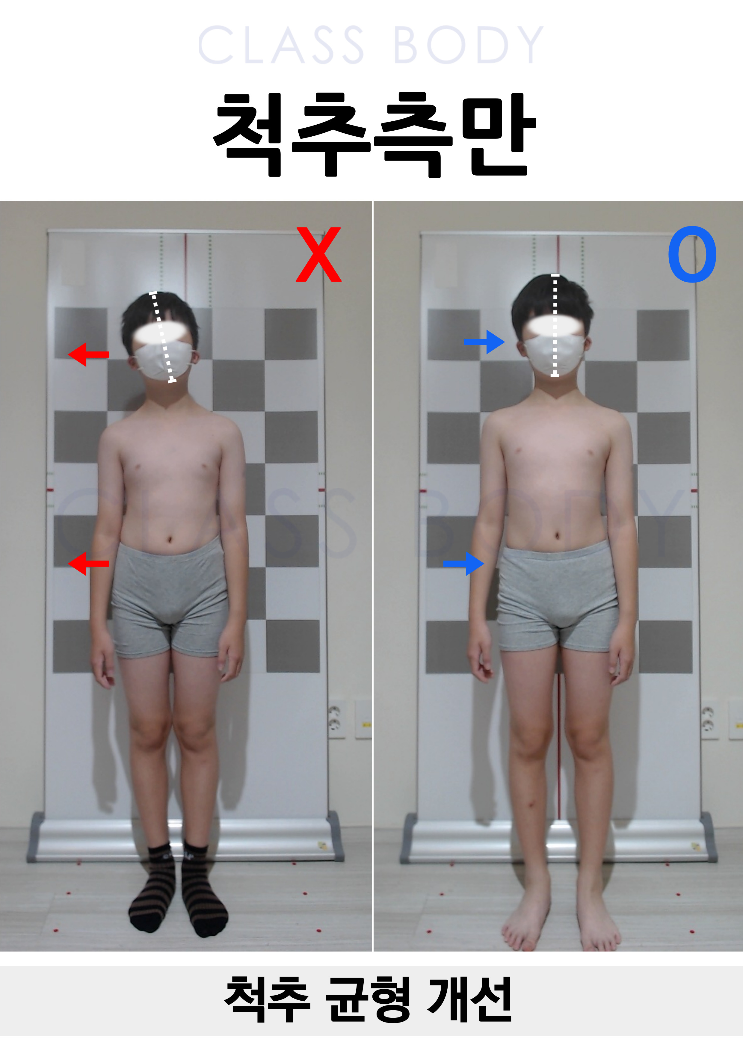 척추측만 개선