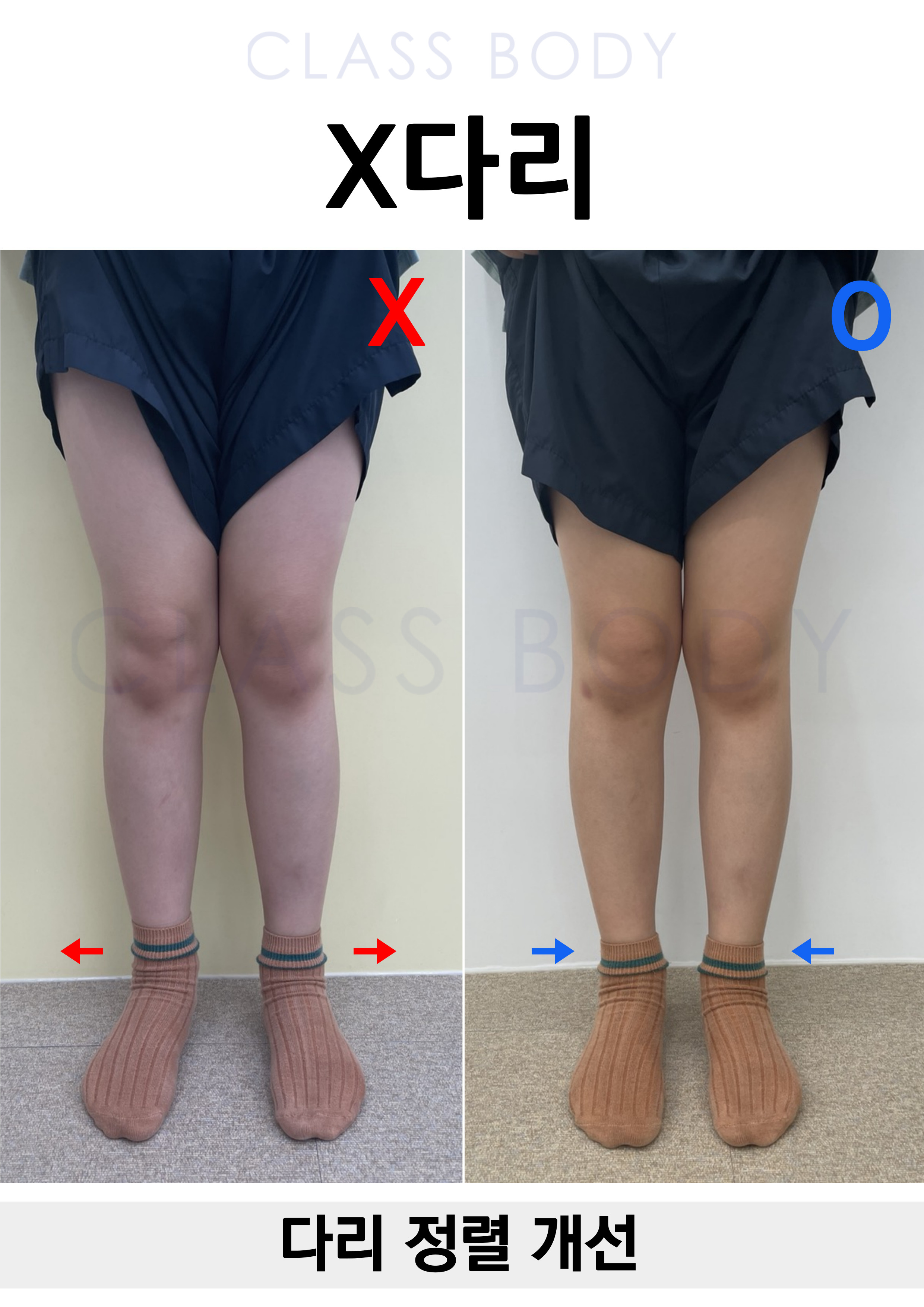 X다리개선