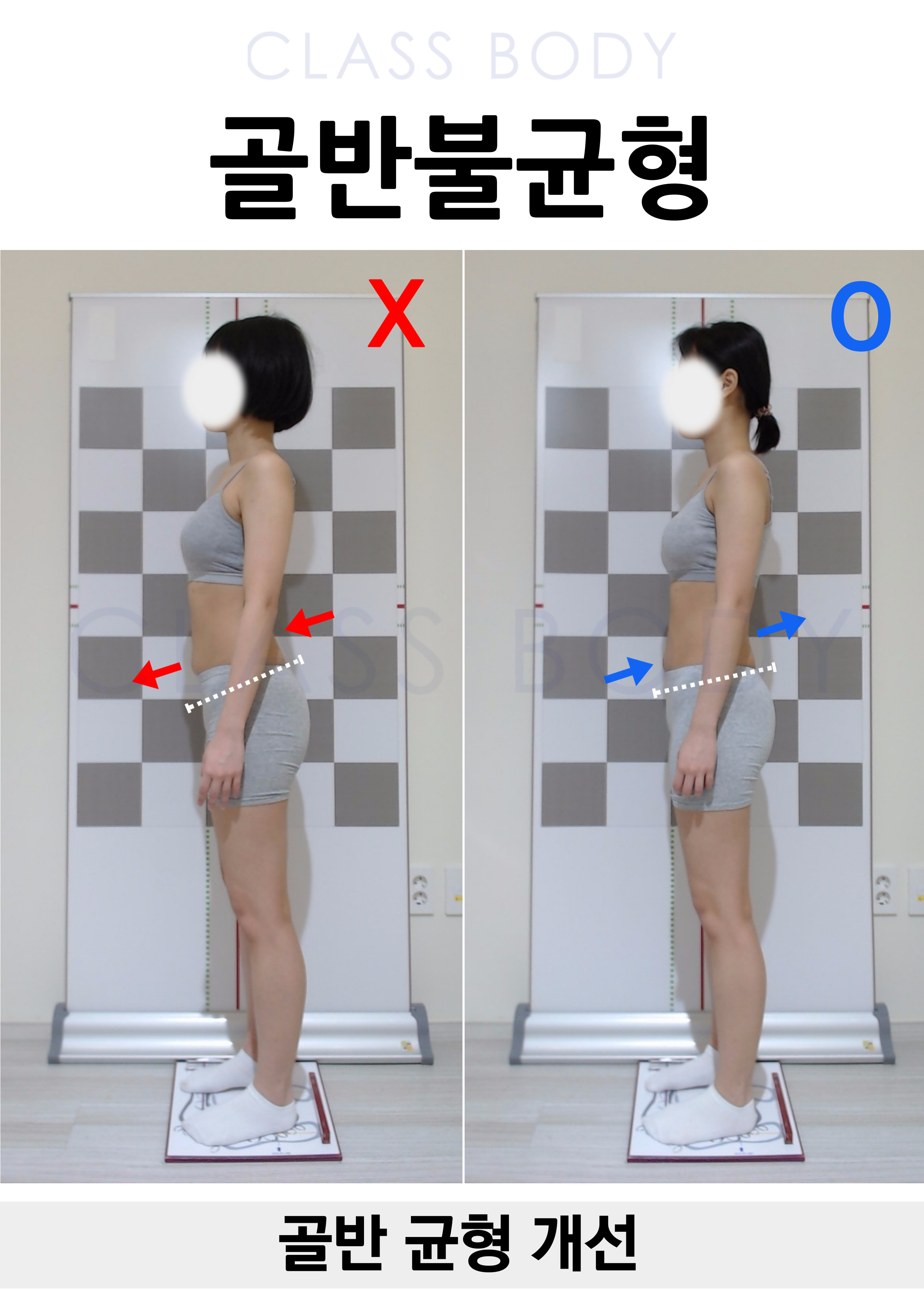 골반 균형 개선