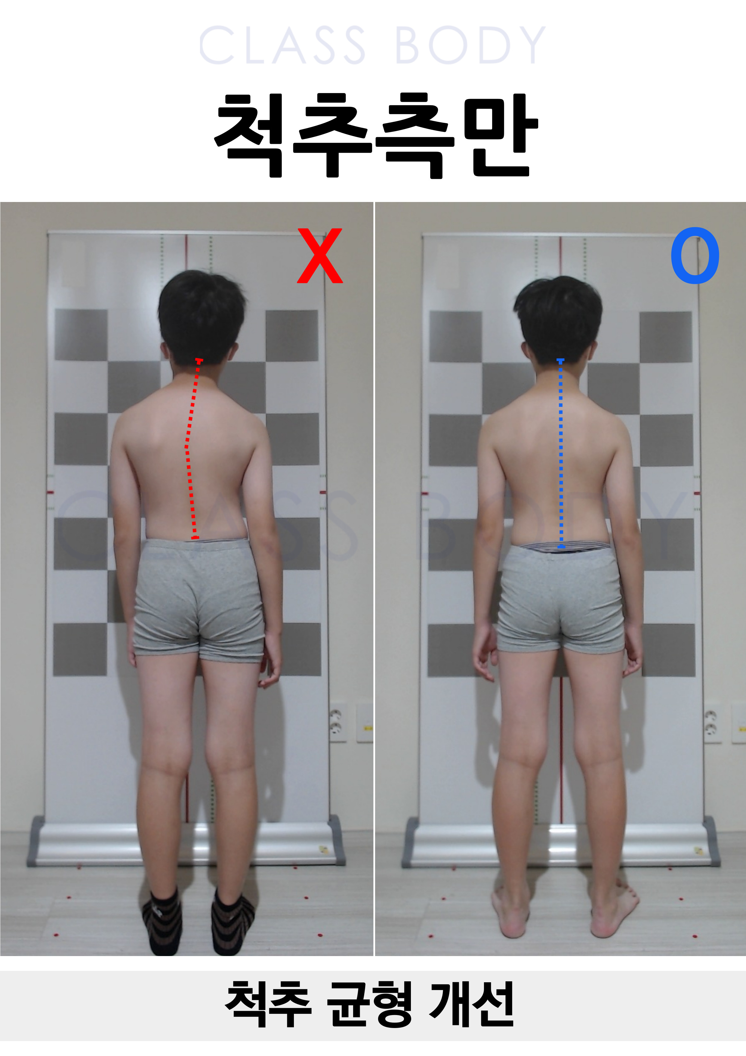 척추측만 개선