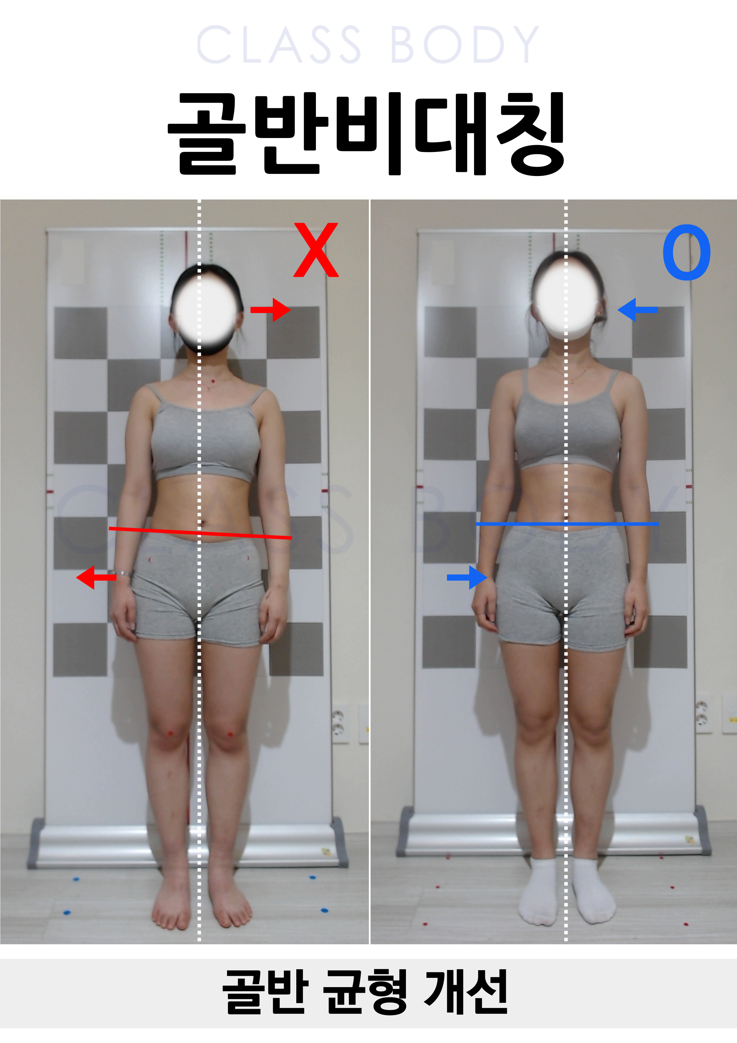 골반 균형 개선