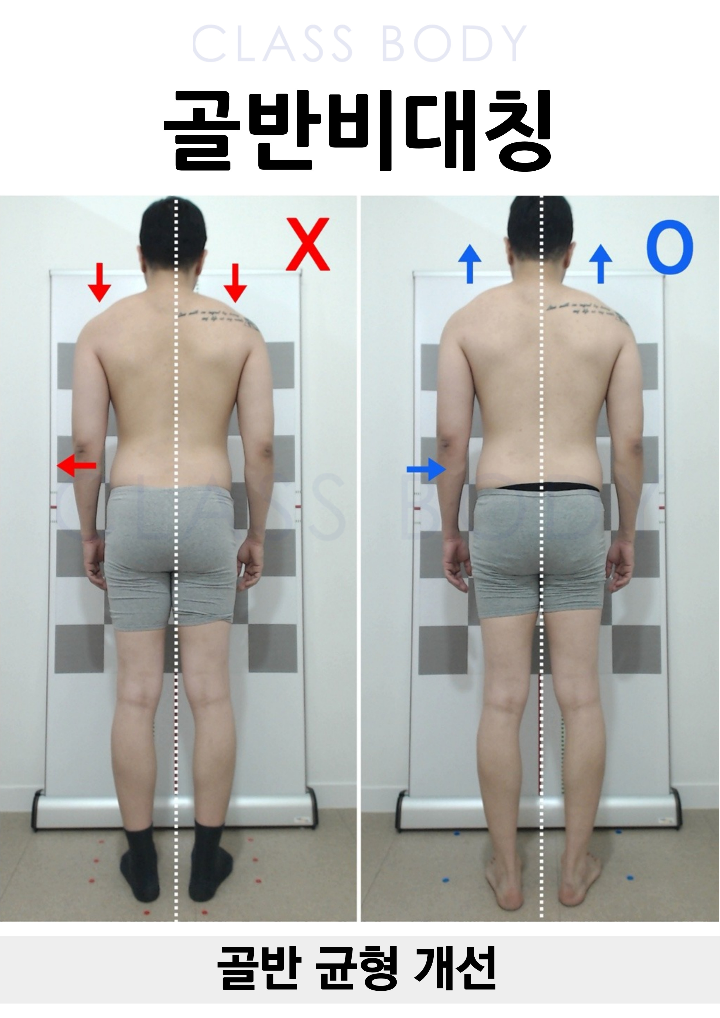 골반 균형 개선