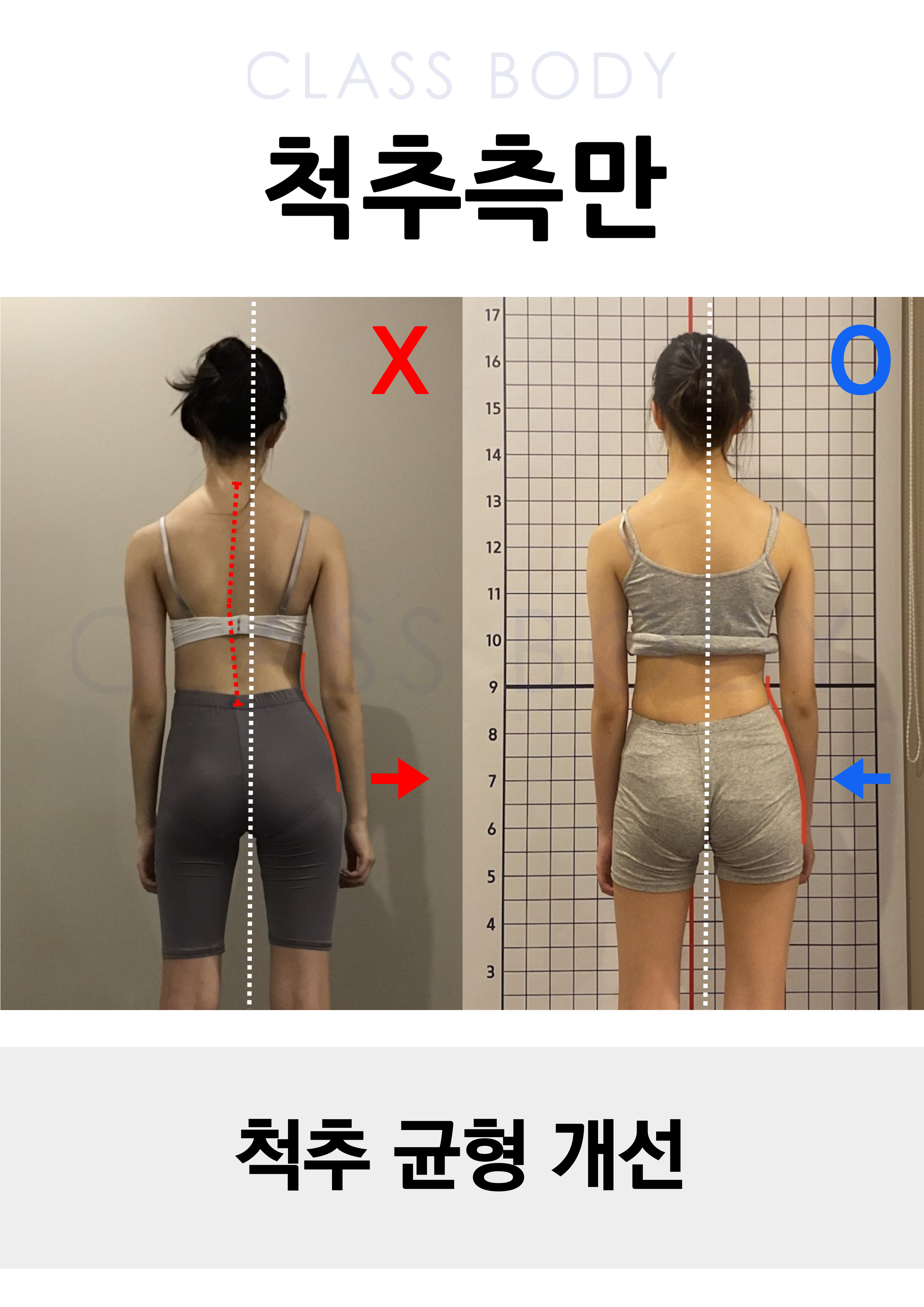 척추측만개선